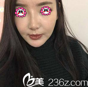 在北京雅靚做面部吸脂第23天效果 在北京雅靚做面部吸脂第23天效果