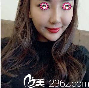 北京雅靚面部吸脂案例 北京雅靚面部吸脂案例