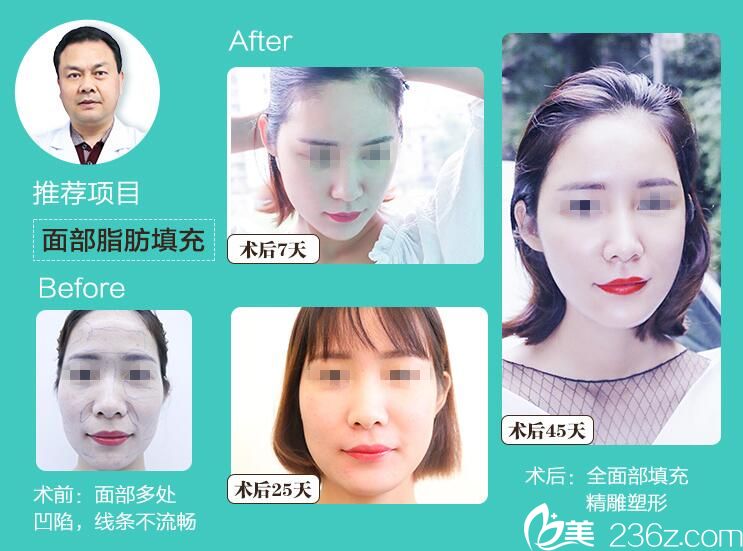 周光瑜面部脂肪填充案例 周光瑜面部脂肪填充案例