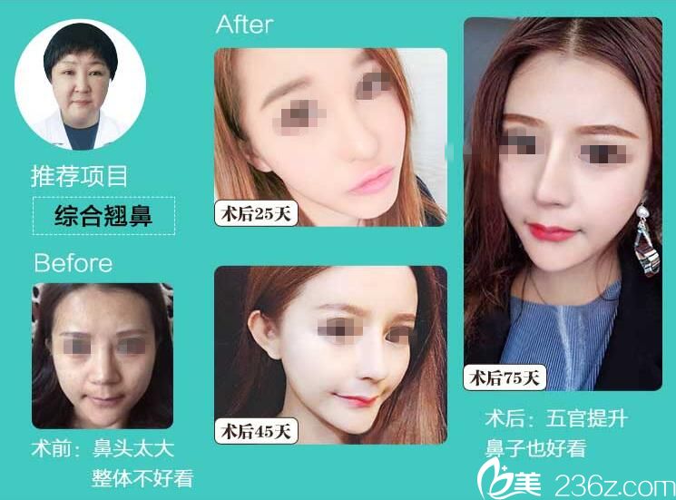 黃立假體隆鼻案例