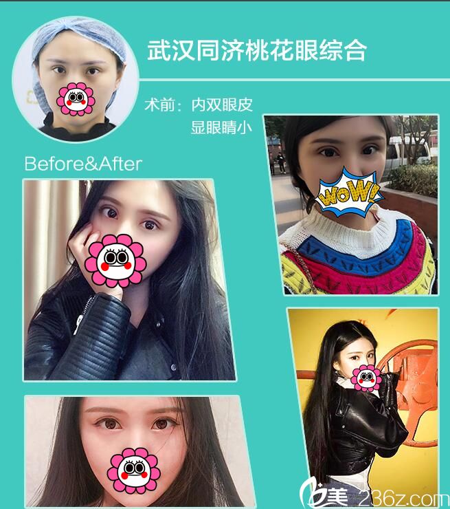 武漢<!--<i data=20240709-sp></i>-->眼綜合案例