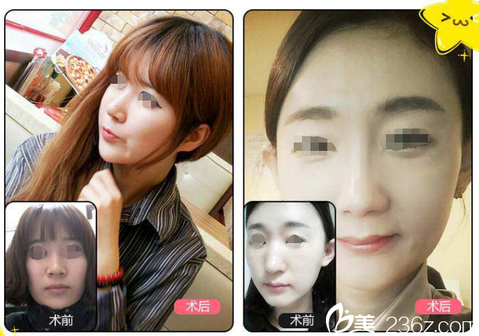 錯(cuò)過(guò)雙11不要慌，蘇州康美12.12整形狂歡項(xiàng)目?jī)r(jià)格表已出：硅膠隆鼻、內(nèi)切去眼袋、埋線提升統(tǒng)統(tǒng)只要1980