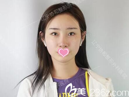 做自體脂肪填充全臉+假體墊下巴術(shù)前照 做自體脂肪填充全臉+假體墊下巴術(shù)前照