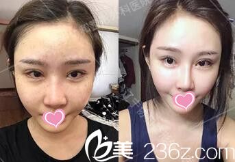 自體脂肪填充全臉術(shù)后第7天 自體脂肪填充全臉術(shù)后第7天