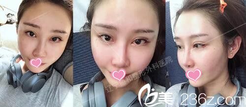 做自體脂肪填充全臉+假體墊下巴術(shù)后半個(gè)月 做自體脂肪填充全臉+假體墊下巴術(shù)后半個(gè)月