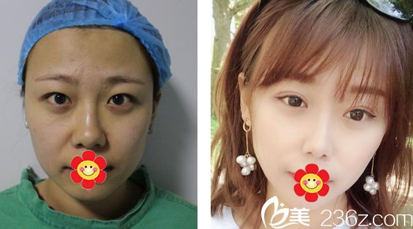 包頭葉子馮守運(yùn)院長全切雙眼皮+自體脂肪面部填充效果 包頭葉子馮守運(yùn)院長全切雙眼皮+自體脂肪面部填充效果