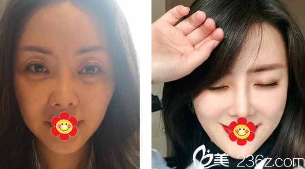 包頭葉子彭?xiàng)澚横t(yī)生假體隆鼻+自體軟骨隆鼻+面部線雕三個(gè)月效果對比案例 包頭葉子彭?xiàng)澚横t(yī)生假體隆鼻+自體軟骨隆鼻+面部線雕三個(gè)月效果對比案例