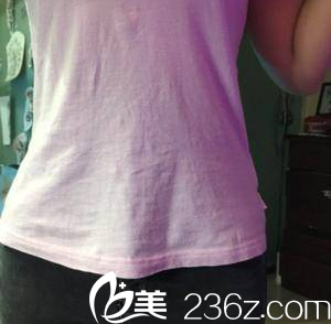 在北京雅靚做水動(dòng)力腰腹吸脂第24天效果 在北京雅靚做水動(dòng)力腰腹吸脂第24天效果