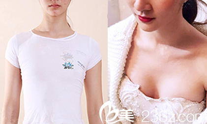 重慶隆胸哪家好？看重慶華美陳德法<span style=