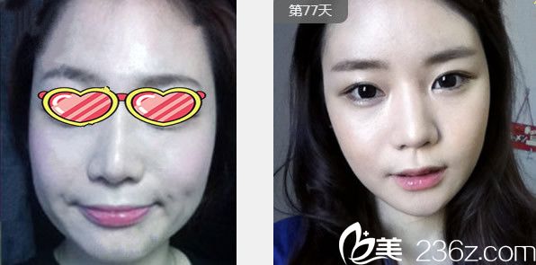 蘭州崔娟大夫下頜角整形效果案例 蘭州崔娟大夫下頜角整形效果案例