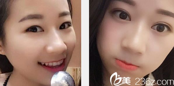 蘭州仁和切開雙眼皮+開眼角效果