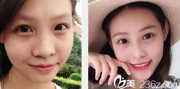 蘭州仁和自體軟骨隆鼻+全臉脂肪填充案例