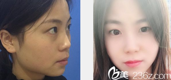 蘭州仁和整形醫(yī)院瘦臉除皺瘦臉及光子嫩膚效果