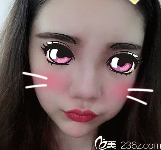 在寧波尚麗找做隆鼻前 在寧波尚麗找做隆鼻前