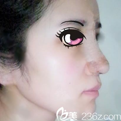 做完鼻綜合隆鼻手術(shù)3天照 做完鼻綜合隆鼻手術(shù)3天照