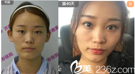 王國明醫(yī)生全切雙眼皮案例