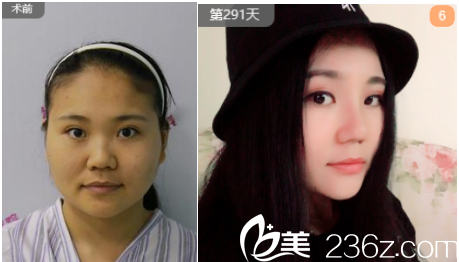 周先超醫(yī)生假體隆鼻案例