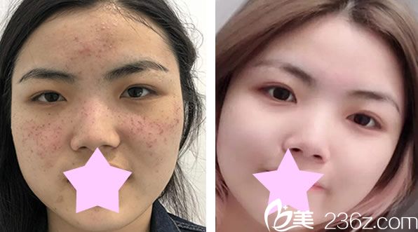 美萊李大鐵院長(zhǎng)祛斑效果對(duì)比圖 美萊李大鐵院長(zhǎng)祛斑效果對(duì)比圖