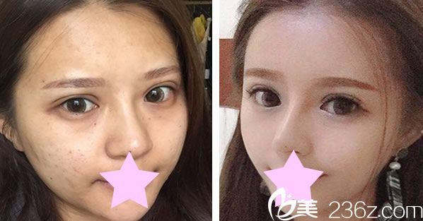 美萊宋萍院長(zhǎng)自體脂肪面部填充效果對(duì)比圖 美萊宋萍院長(zhǎng)自體脂肪面部填充效果對(duì)比圖