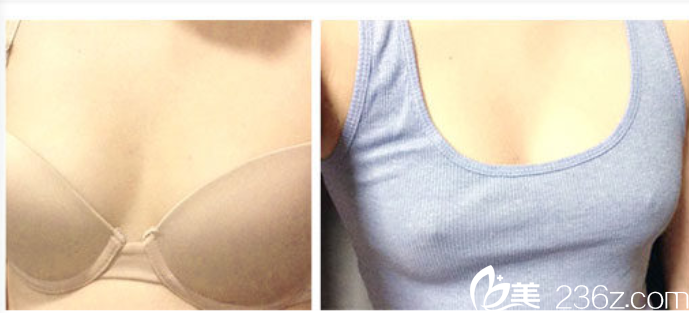 韓國ID醫(yī)院無痛假體隆胸手術(shù)術(shù)前 韓國ID醫(yī)院無痛假體隆胸手術(shù)術(shù)前