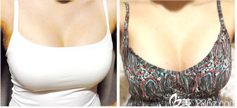 韓國ID醫(yī)院無痛假體隆胸手術(shù)術(shù)后15天 韓國ID醫(yī)院無痛假體隆胸手術(shù)術(shù)后15天