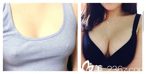 韓國ID醫(yī)院無痛假體隆胸術(shù)前術(shù)后對比圖 韓國ID醫(yī)院無痛假體隆胸術(shù)前術(shù)后對比圖