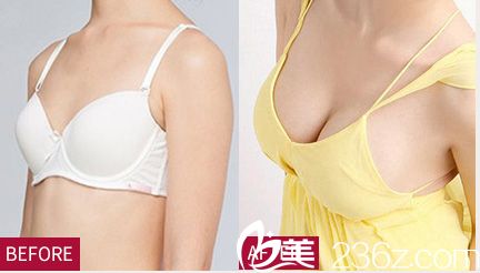 醫(yī)生隆胸案例 醫(yī)生隆胸案例