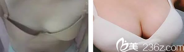 醫(yī)生自體脂肪隆胸案例 醫(yī)生自體脂肪隆胸案例