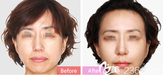 祁薇主任除皺案例 祁薇主任除皺案例