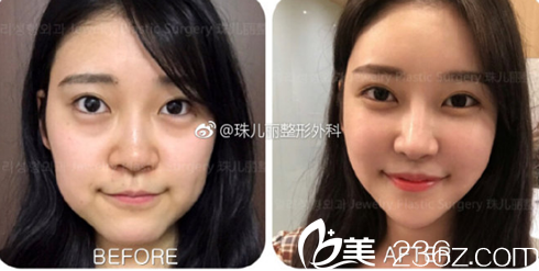 瘦臉多少錢？雙12蕪湖珠兒麗整形優(yōu)惠價(jià)格表公布，其中瘦臉680元起