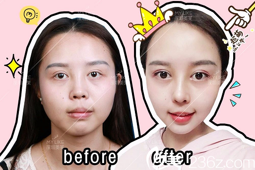 深圳美萊龍鵬輝做的鼻綜合隆鼻案例對(duì)比圖 深圳美萊龍鵬輝做的鼻綜合隆鼻案例對(duì)比圖