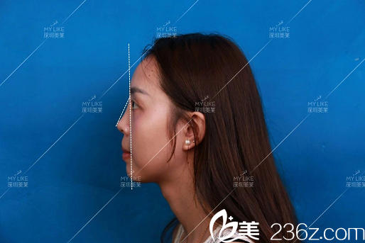 隆鼻術(shù)前照片 隆鼻術(shù)前照片