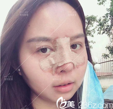 深圳美萊龍鵬輝隆鼻術(shù)后九天 深圳美萊龍鵬輝隆鼻術(shù)后九天