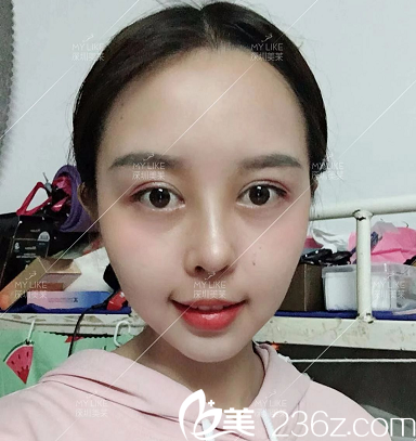 深圳美萊龍鵬輝鼻頭鼻翼縮小術(shù)后15天圖片 深圳美萊龍鵬輝鼻頭鼻翼縮小術(shù)后15天圖片