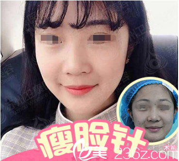 國產(chǎn)蘭州瘦臉除皺瘦臉案例