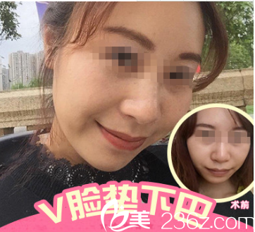 硅膠墊下巴案例