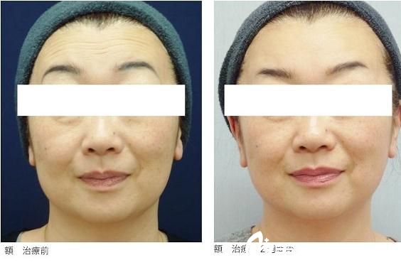 青山エルクリニック瘦臉除皺去皺