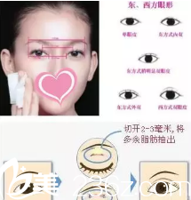 全切雙眼皮手術示意圖