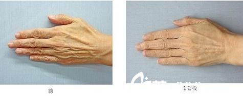 杉野宏子玻尿酸注射