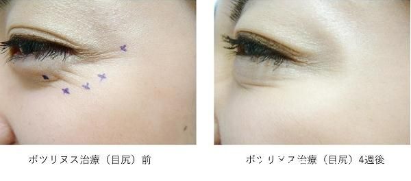 杉野宏子瘦臉除皺注射