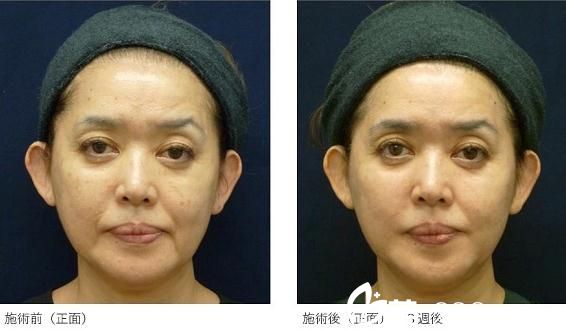 杉野宏子面部拉皮