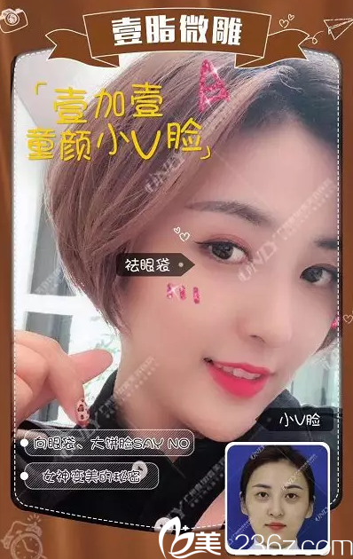 廣州壹加壹自體脂肪全臉填充實例 廣州壹加壹自體脂肪全臉填充實例