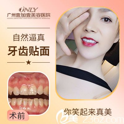 廣州壹加壹做的牙齒瓷貼面實例 廣州壹加壹做的牙齒瓷貼面實例