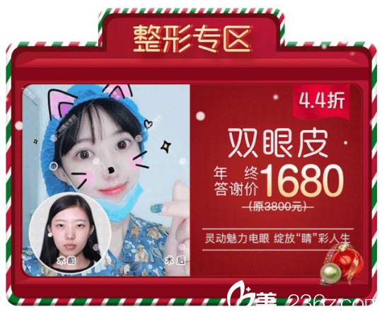 廣州曙光王娟做的全切雙眼皮案例