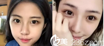 德州友誼醫(yī)院全切雙眼皮案例