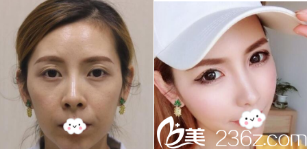 德州友誼醫(yī)院隆鼻案例