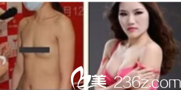 德州友誼整形醫(yī)院隆胸案例