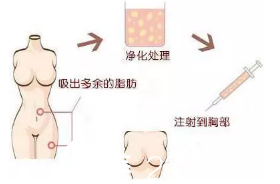 自體脂肪隆胸示意圖