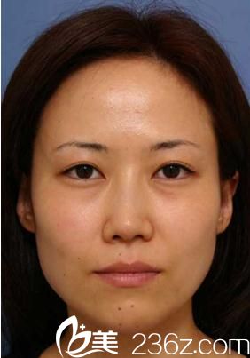 福田慶三全切雙眼皮前 福田慶三全切雙眼皮前