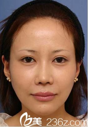 在日本美真美容的福田慶三醫(yī)生那里做了切開雙眼皮，我也有了明眸善睞